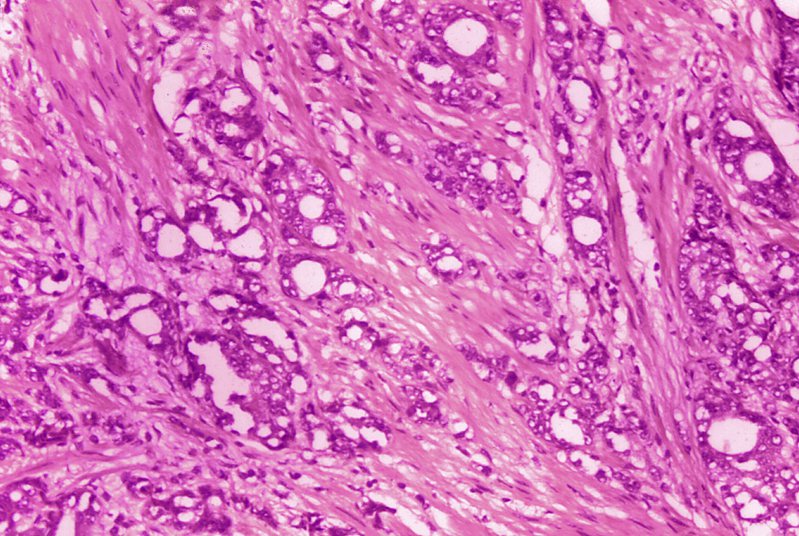 为了避免不必要手术和放射线治疗，医师建议将低恶性前列腺癌的「癌」字拿掉。（美联社）(photo:UDN)