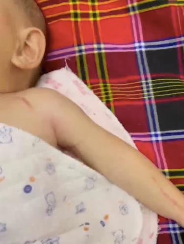 郭女控訴醫生拉斷嬰兒的手，導致寶寶左手癱瘓。（取材自天目新聞）