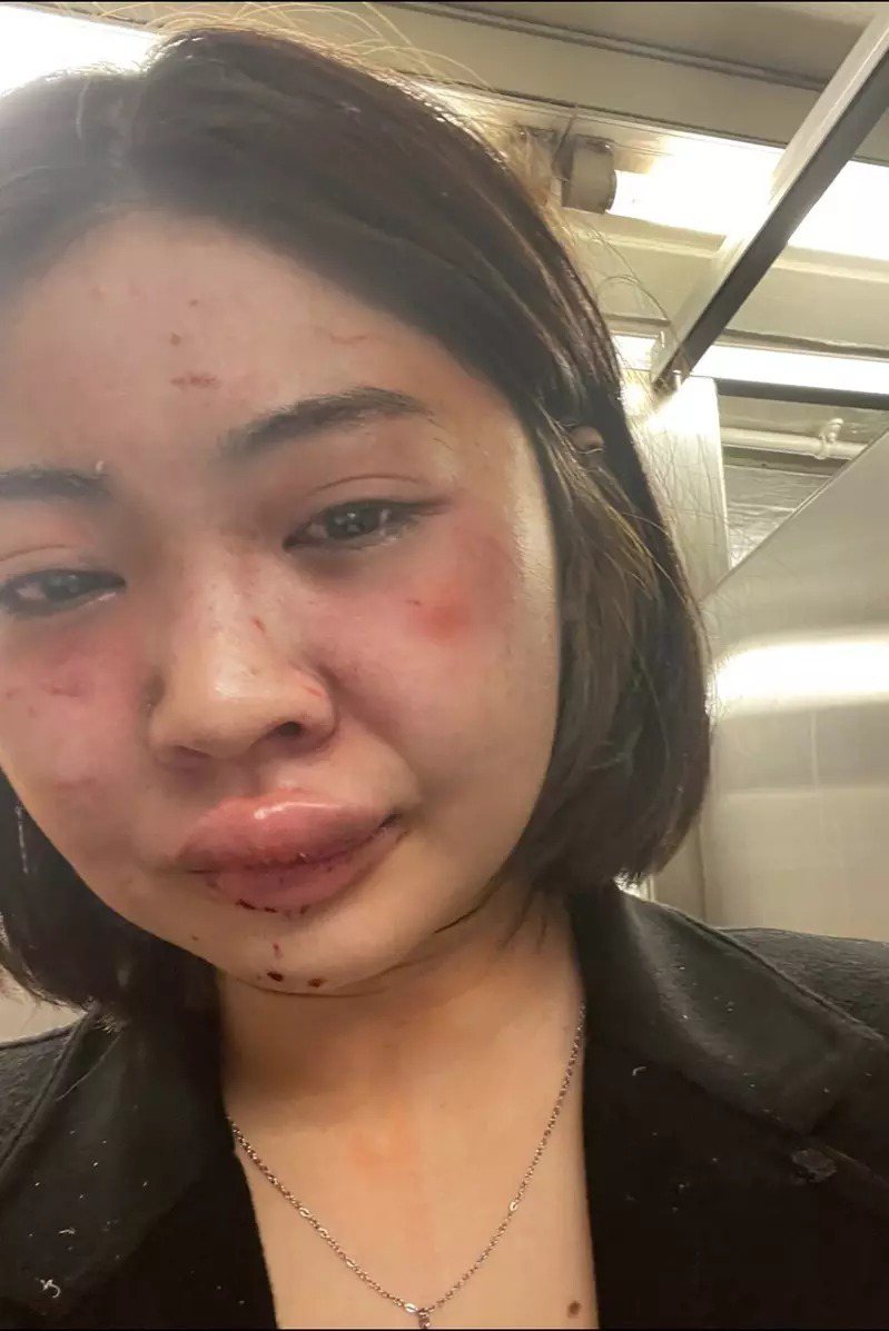 泰国模特儿Jirajariyawetch在地铁站被攻击，面部布满伤痕。(取自推特)(photo:UDN)