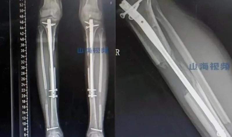 一名19歲少女認為自己太矮，竟做了「斷骨增高」手術，術後卻因反覆感染以致無法行走。（翻攝自山海影片）