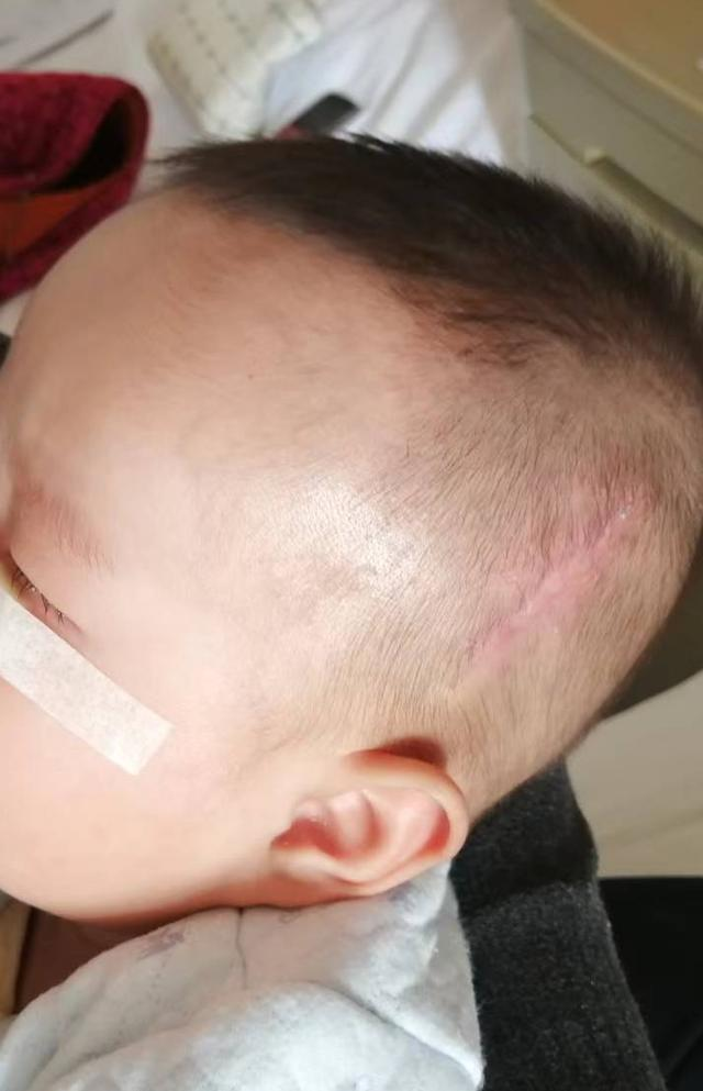 陜西一男婴输液时针头导管留在体内，图为男婴首次手术后留下的疤。图／取材自潇湘晨报