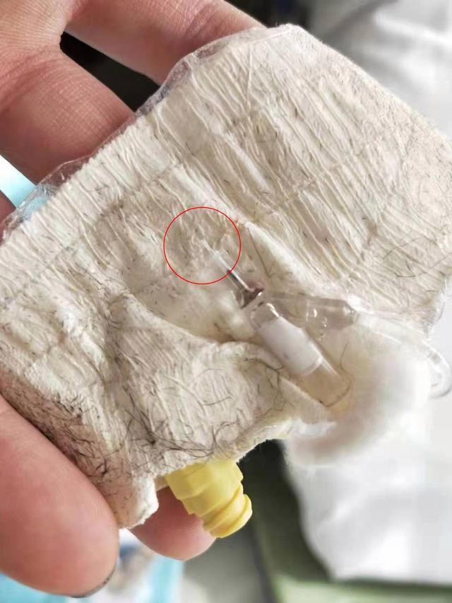 陜西一男婴输液时针头导管留在体内。图／取材自潇湘晨报
